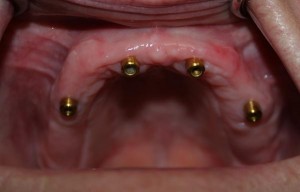 Upper Denture Implant