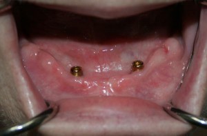 Lower Denture Implant